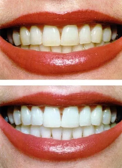 before and after results of teeth whitening procedure offered at Evergreen Smile Studio
