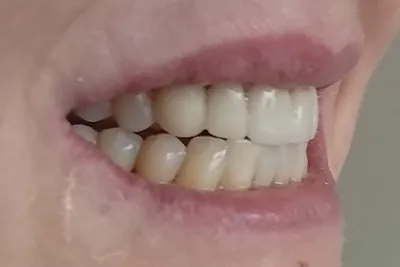 closeup of a person's smile after getting dental veneers
