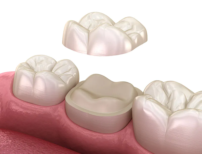 Dental crown above a prepared tooth, 3D illustration